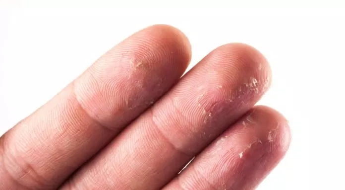 Dấu hiệu của làn da tay bị khô (Nguồn:Internet)