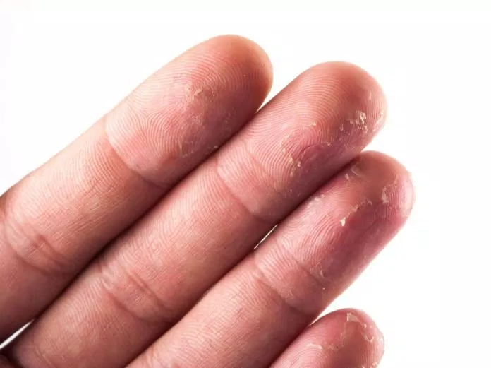 Dấu hiệu của làn da tay bị khô (Nguồn:Internet)