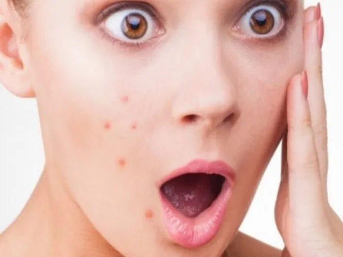 Nổi mụn cũng là một cách mà cơ thể đang giao tiếp với chúng ta. (Nguồn: internet)