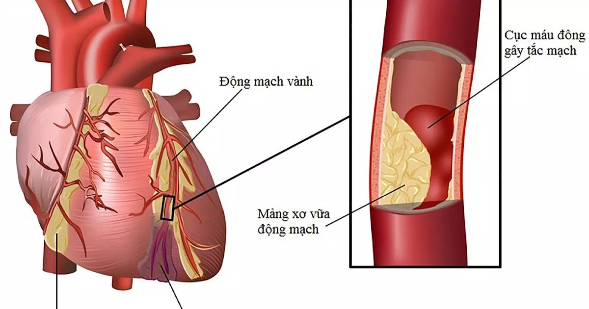 Tim mạch biến chứng tiểu đường