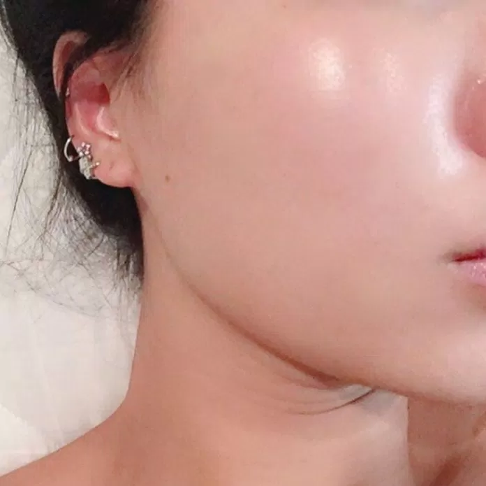 Nếu kiên trì sử dụng các sản phẩm chứa Salicylic Acid đúng cách, các nốt mụn sẽ nhanh chóng khô và lộ cồi, số lượng mụn trên da sẽ giảm đáng kể (Ảnh: Internet)