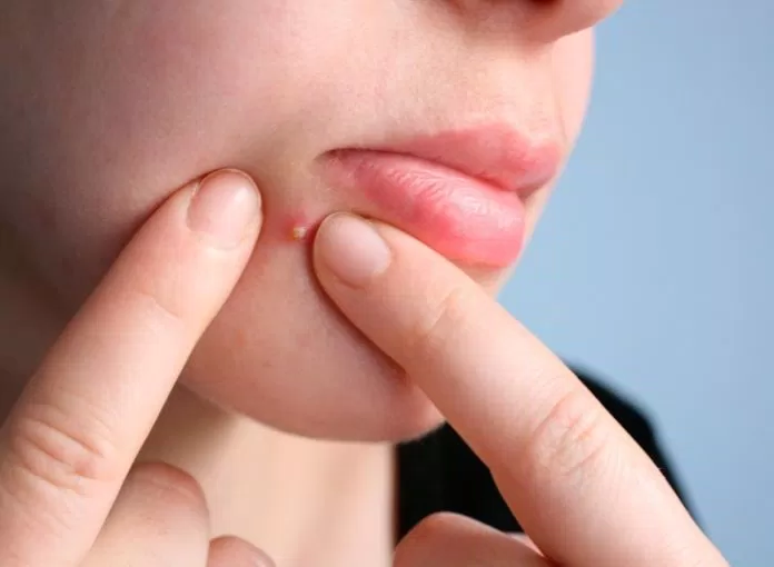 Trước khi dùng tay chạm lên mặt để rửa hay nặn mụn, chúng ta nên vệ sinh tay sạch sẽ trước đó (Ảnh: Internet)