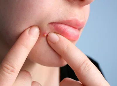 Trước khi dùng tay chạm lên mặt để rửa hay nặn mụn, chúng ta nên vệ sinh tay sạch sẽ trước đó (Ảnh: Internet)