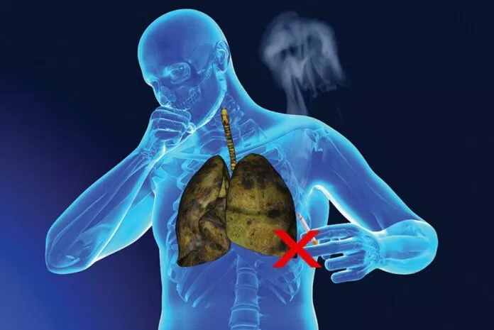 hút thuốc lá gây ung thư phổi