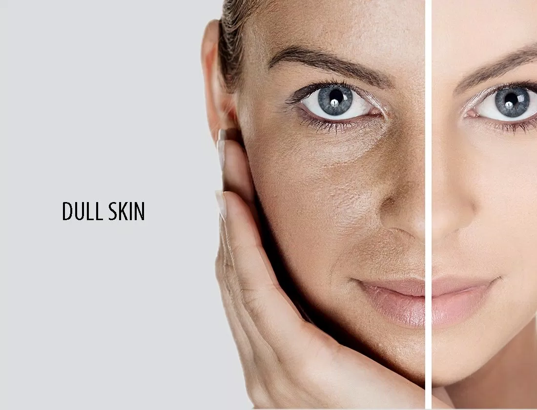 Làn da xỉn màu khiến bạn kém tự tin Làn da xỉn màu khiến bạn kém tự tin