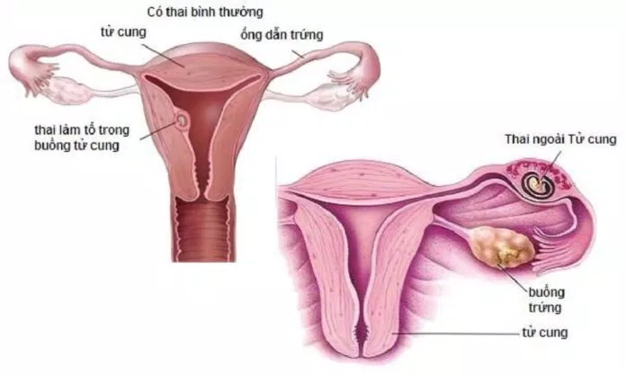 giải phẫu thai ngoài tử cung