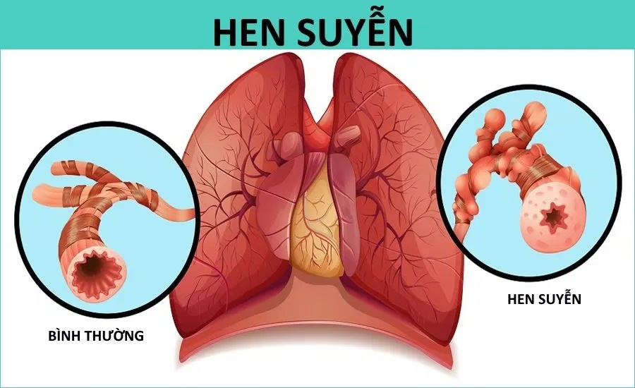 Hen suyễn là nỗi ám ảnh với nhiều người. Nhưng saffron có thể chữa khỏi nó Hen suyễn là nỗi ám ảnh với nhiều người. Nhưng saffron có thể chữa khỏi nó