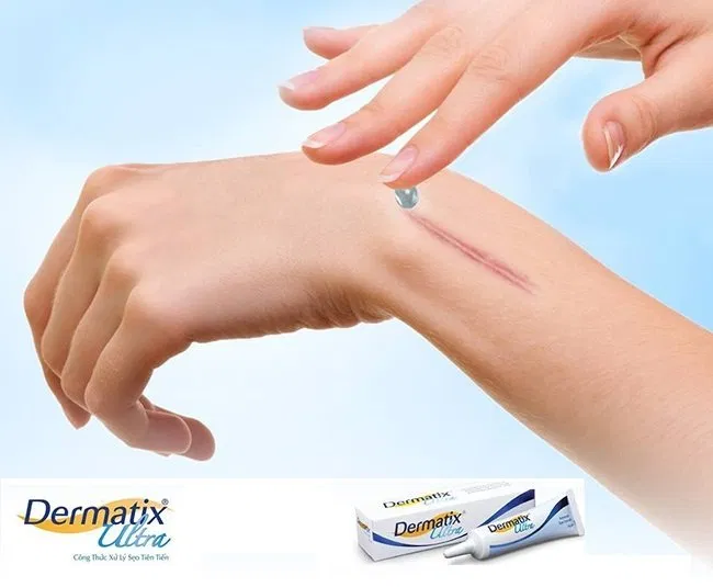 Kem trị sẹo Dermatix Ultra (Nguồn: Internet) Kem trị sẹo Dermatix Ultra (Nguồn: Internet)