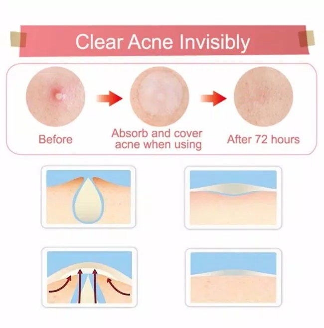 Miếng dán mụn Some By Mi Clear Spot Patch