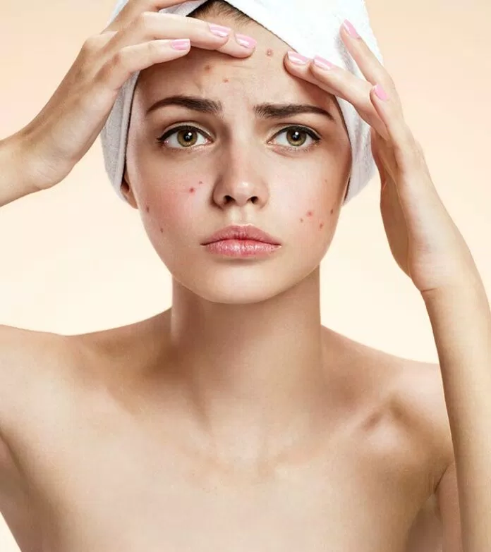 Mụn trứng cá và thâm mụn là ác mộng của các cô gái Mụn trứng cá và thâm mụn là ác mộng của các cô gái