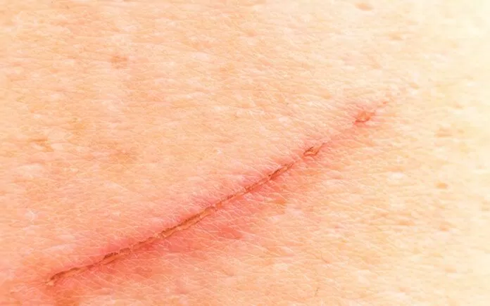 Dùng nghệ tây để trị sẹo, trả lại vẻ đẹp cho làn da của bạn Dùng nghệ tây để trị sẹo, trả lại vẻ đẹp cho làn da của bạn
