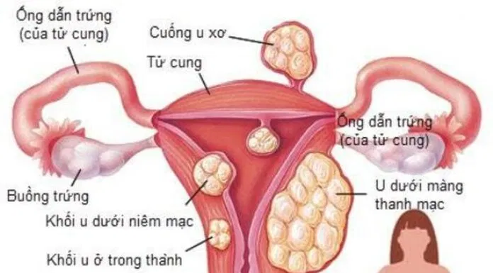 vị trí u xơ