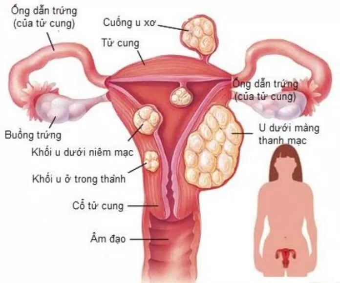 vị trí u xơ