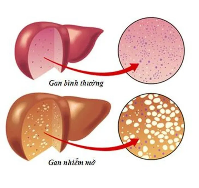 gan nhiễm mỡ