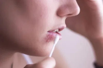 Tránh xa quả óc chó nếu bạn bị mụn rộp Tránh xa quả óc chó nếu bạn bị mụn rộp
