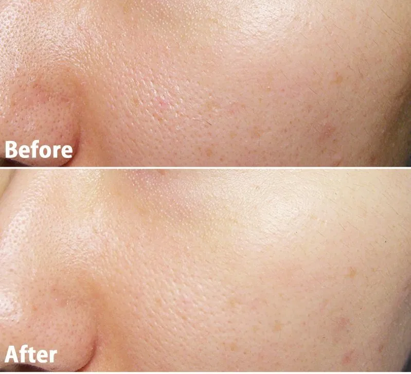 Sau khi sử dụng da mặt căng bóng và lỗ chân lông được thu nhỏ thấy rõ.(nguồn: Internet)