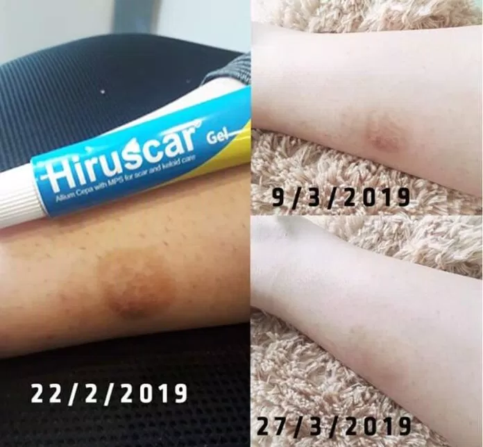 gel trị sẹo Hiruscar có công dụng rất hiệu quả (Nguồn: Vitamintie) gel trị sẹo Hiruscar có công dụng rất hiệu quả (Nguồn: Vitamintie)