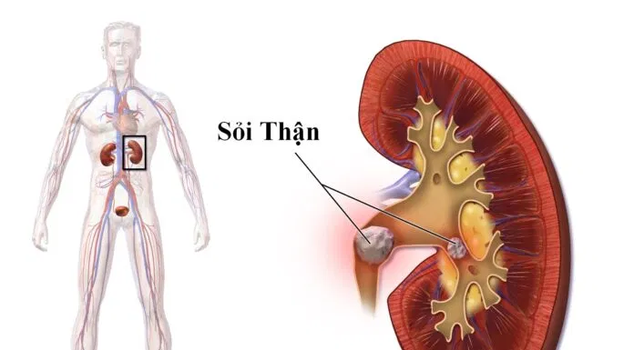 sỏi kích thước lớn