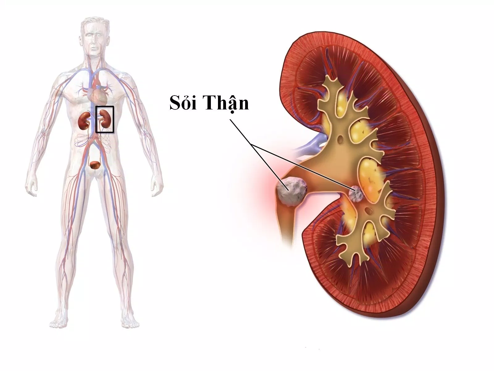  sỏi kích thước lớn