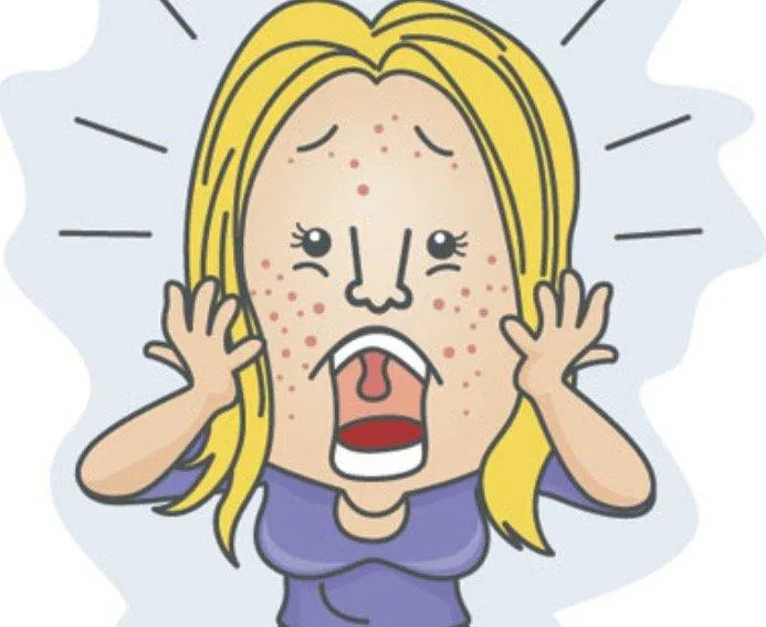 Nếu lạm dụng hoặc sử dụng Salicylic acid không đúng cách sẽ gây các vấn đề về da như mẩn đỏ, khô da. (ảnh internet)