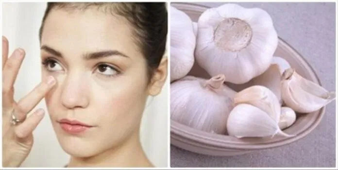 trị mụn gọa bằng tỏi Tỏi không những tốt cho sức khỏe mà còn có thể điều trị các bệnh lý về da. (nguồn: Internet)