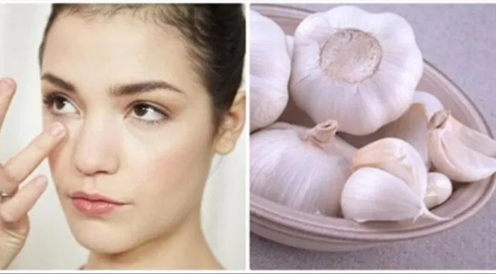 trị mụn gọa bằng tỏi Tỏi không những tốt cho sức khỏe mà còn có thể điều trị các bệnh lý về da. (nguồn: Internet)