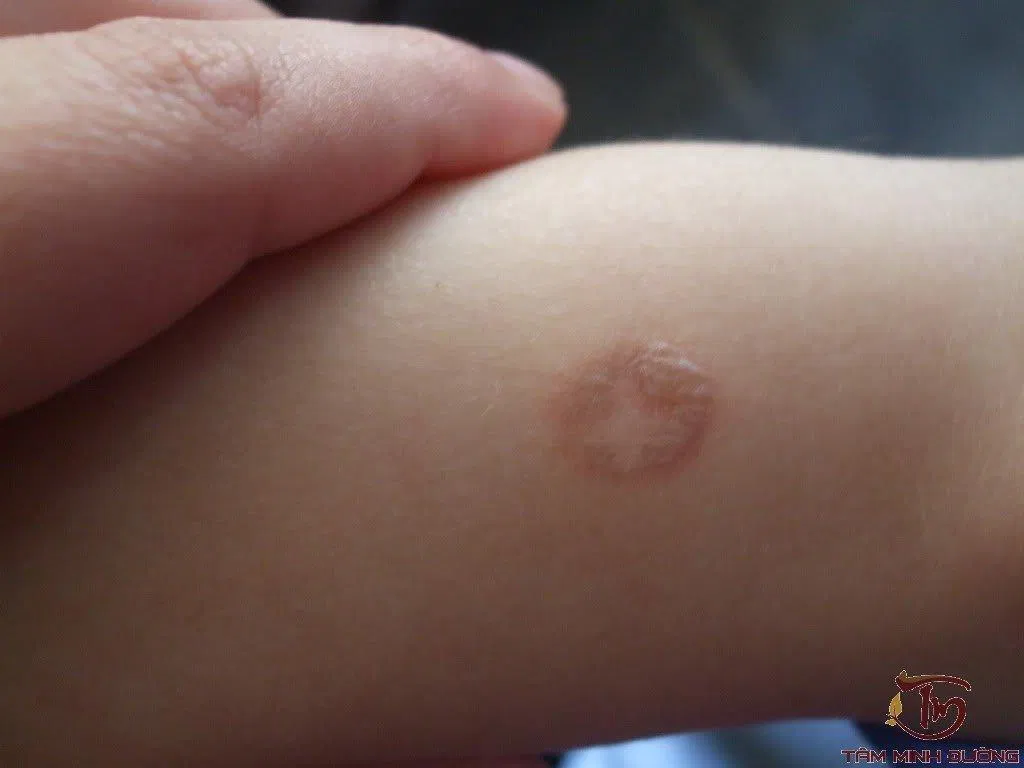 bệnh hắc lào là gì