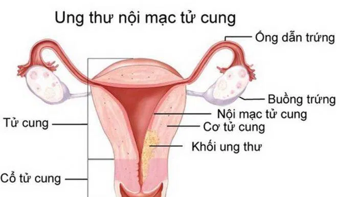 tử cung