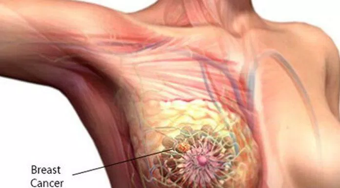 Ung thư vú: nguyên nhân, triệu chứng và cách điều trị