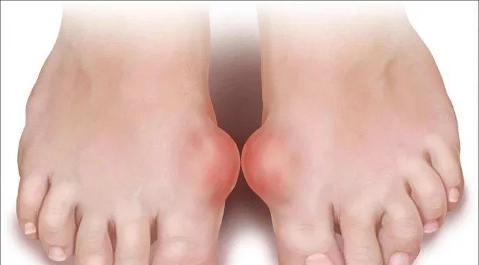 bệnh gout