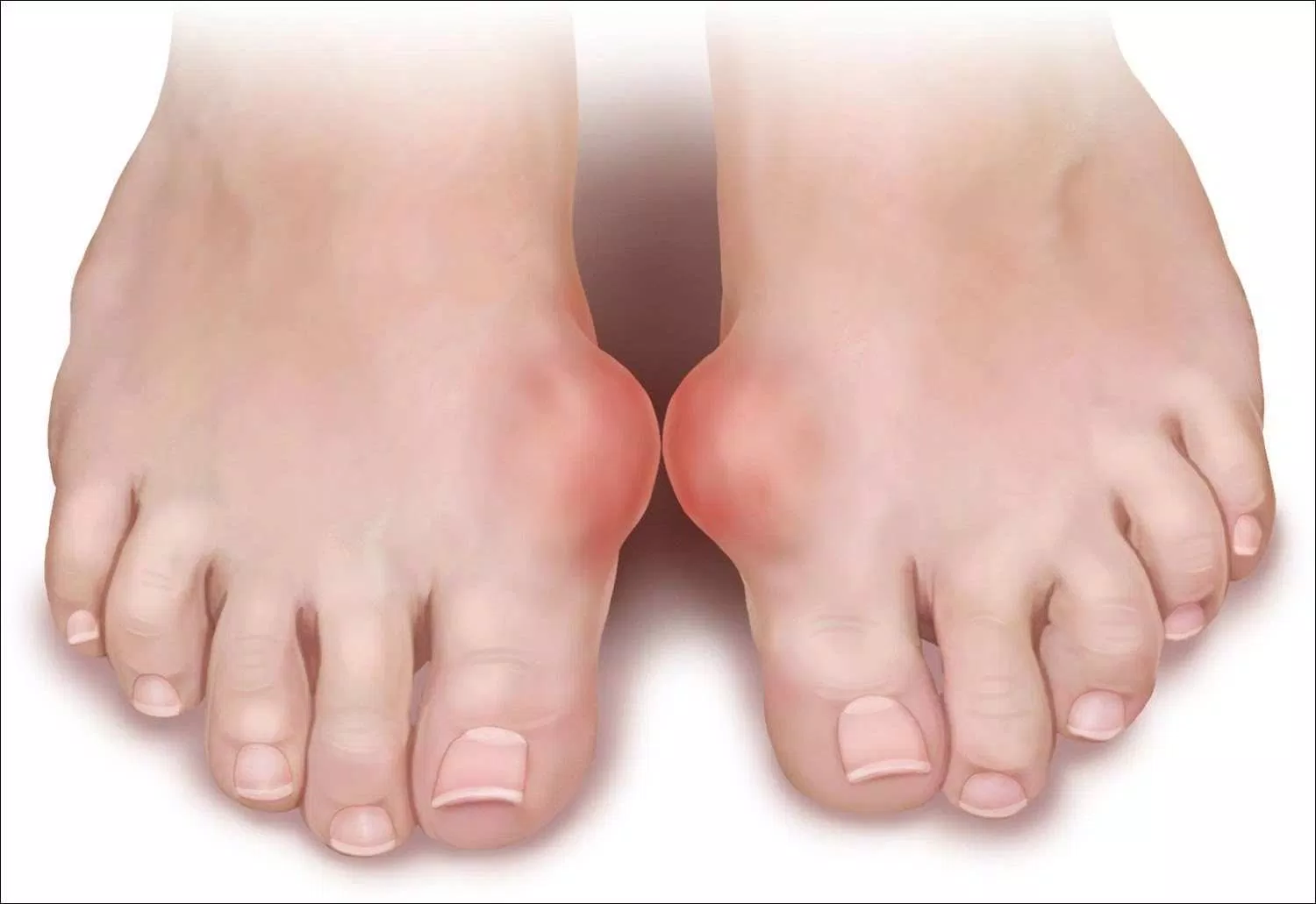 bệnh gout