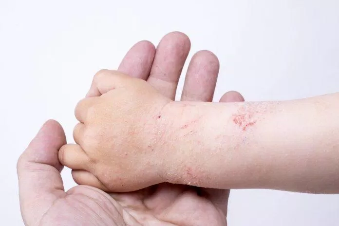 viêm da dị ứng