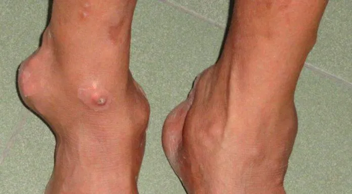 biến chứng gout