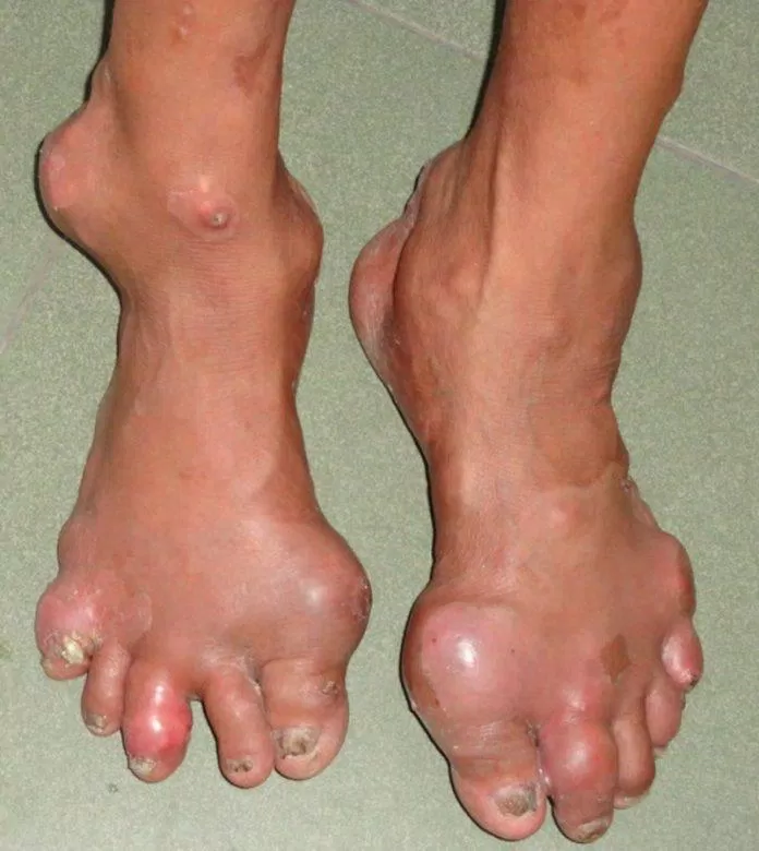 biến chứng gout