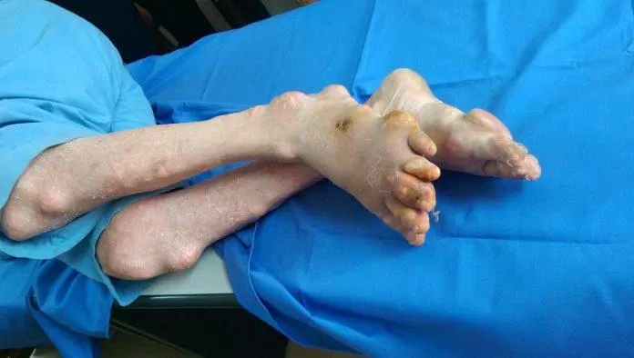 biến chứng bệnh gout