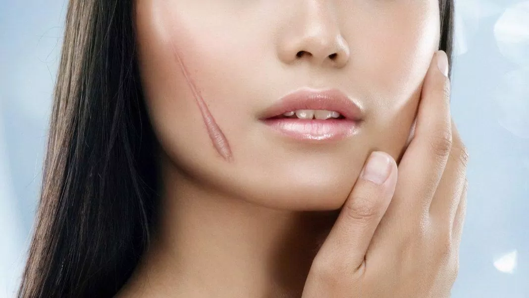 Bị sẹo nên kiêng ăn những gì