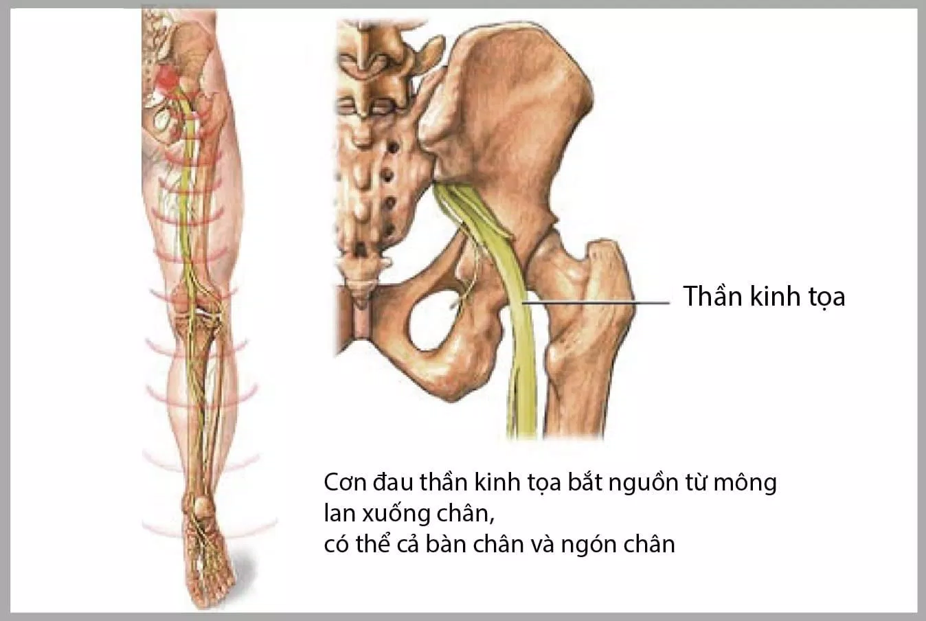 đau dây thần kinh tọa