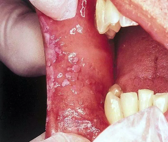 dấu hiệu bệnh lậu