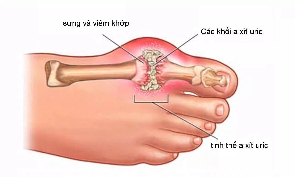 gout cấp