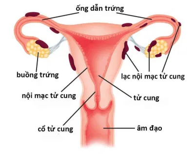 Lạc nội mạc tử cung