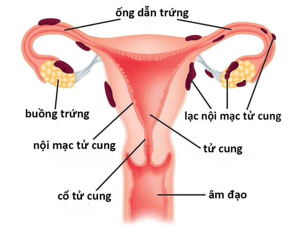 Lạc nội mạc tử cung