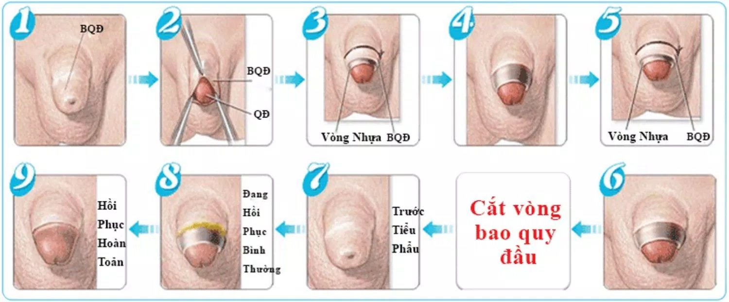 quy trình cắt bao quy đầu