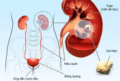 sỏi thận