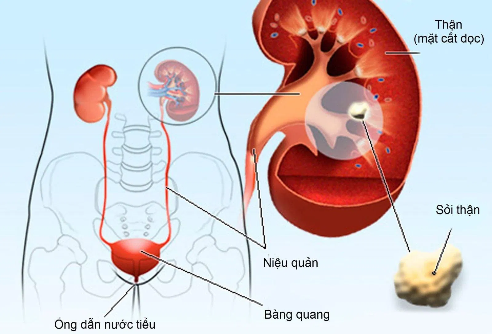 sỏi thận