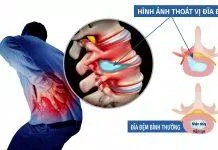 thoát vị đĩa đệm