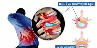 thoát vị đĩa đệm