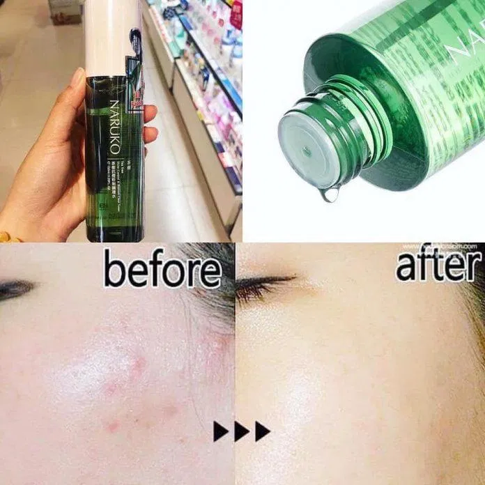 Khả năng trị mụn của Naruko Tea Tree Toner rất tốt (Nguồn: Internet)