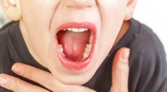 viêm họng hạt