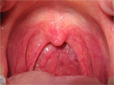 viêm họng hạt