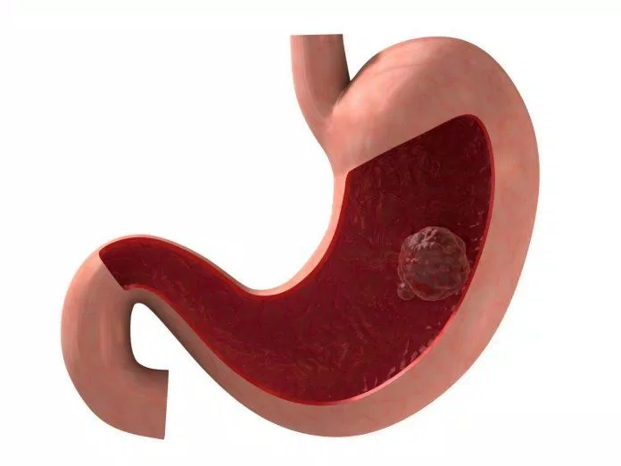 viêm loét dạ dày